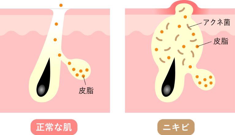 にきびについて