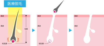 医療レーザー脱毛とは