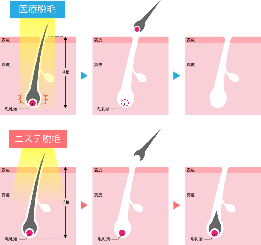 医療脱毛とエステ脱毛の違い